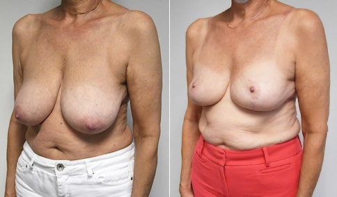 https://www.drjhall.com/wp-content/uploads/2019/11/Hall_Boston_Breast-Reduction-Asymmetry-55-Left-OBL-1.jpg