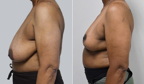 Gynecomastia Patient 38  Jonathan Hall, MD, FACSJonathan Hall, MD, FACS