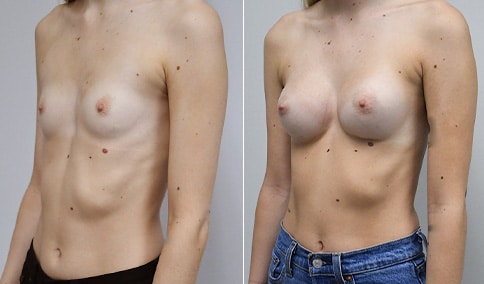 Breast Reconstruction with Ideal Implants – Patient 312