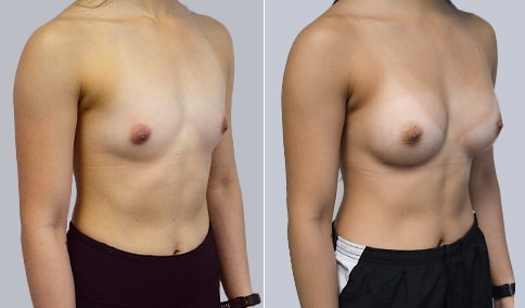 https://www.drjhall.com/wp-content/uploads/2020/05/Hall_Boston_Breast-Augmentation-75-Right-OBL-1.jpg