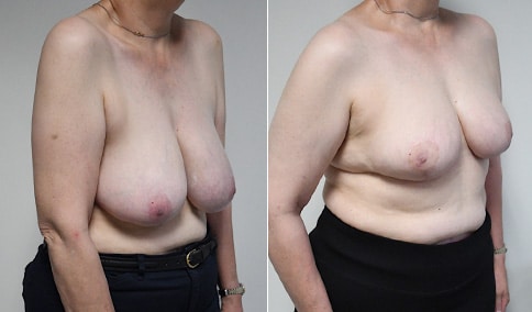 Breast Reduction – Patient 212  Jonathan Hall, MD, FACSJonathan Hall, MD,  FACS