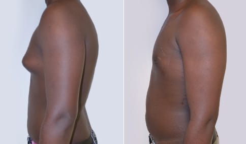 Gynecomastia Patient 38  Jonathan Hall, MD, FACSJonathan Hall, MD, FACS