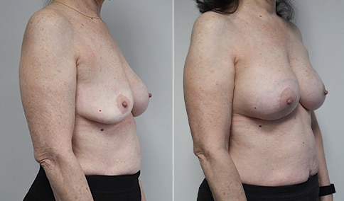 Breast Augmentation Revision – Patient 315  Jonathan Hall, MD,  FACSJonathan Hall, MD, FACS