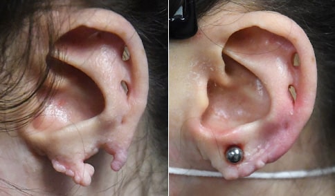 Repairing Gauge or Stretched Earlobes with Plastic Surgery