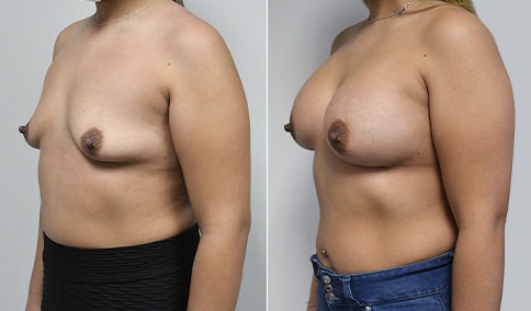 Breast Augmentation – Patient 319