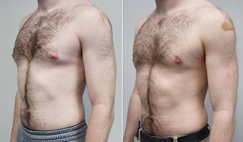 Gynecomastia Patient 38  Jonathan Hall, MD, FACSJonathan Hall, MD, FACS