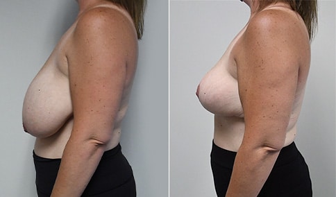 https://www.drjhall.com/wp-content/uploads/2021/07/Hall_Boston_Breast-Reduction-81-Left-LAT.jpg