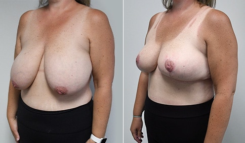 Breast Reduction – Patient 201  Jonathan Hall, MD, FACSJonathan