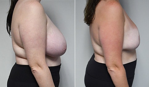 Breast Reduction Patient #125  Jonathan Hall, MD, FACSJonathan