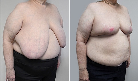 Breast Reduction – Patient 204  Jonathan Hall, MD, FACSJonathan
