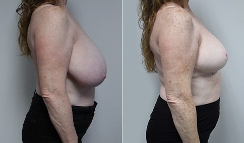 Breast Reduction – Patient 205  Jonathan Hall, MD, FACSJonathan