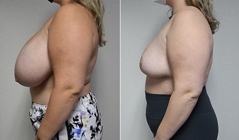 Breast Reduction in Boston, MA