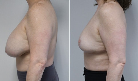 Gynecomastia Patient 38  Jonathan Hall, MD, FACSJonathan Hall, MD, FACS