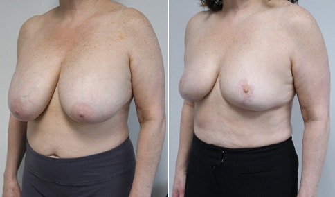 Breast Augmentation Revision – Patient 315