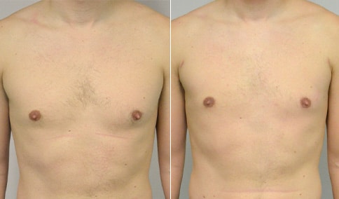 Gynecomastia Patient 38  Jonathan Hall, MD, FACSJonathan Hall, MD, FACS