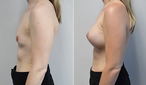Breast Augmentation with Ideal Implants – Patient 330