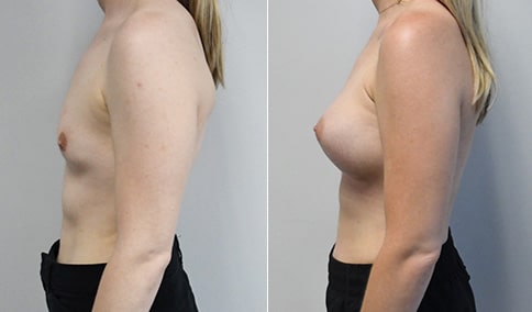 Breast Augmentation with Ideal Implants – Patient 330 | Jonathan Hall, MD,  FACSJonathan Hall, MD, FACS