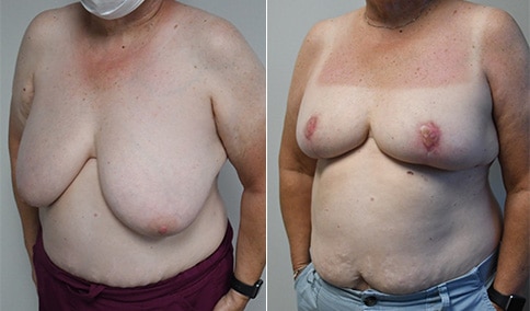 Breast Reduction 113  Jonathan Hall, MD, FACSJonathan Hall, MD, FACS