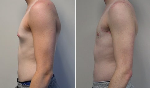 Gynecomastia Patient 38  Jonathan Hall, MD, FACSJonathan Hall, MD, FACS