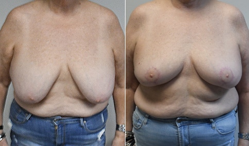 Breast Reduction Patient 120  Jonathan Hall, MD, FACSJonathan