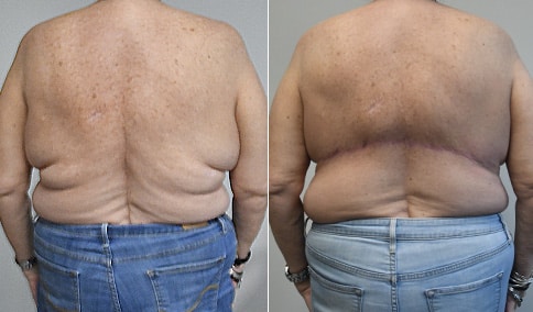 Breast Reduction Patient #125  Jonathan Hall, MD, FACSJonathan