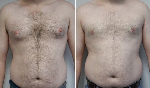 Gynecomastia Patient 37  Jonathan Hall, MD, FACSJonathan Hall, MD, FACS