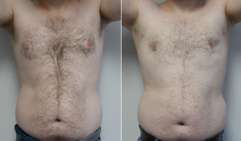 Gynecomastia Patient 37  Jonathan Hall, MD, FACSJonathan Hall, MD, FACS