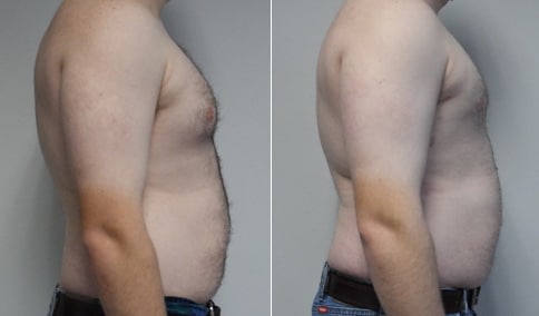 Gynecomastia Patient 38  Jonathan Hall, MD, FACSJonathan Hall, MD, FACS