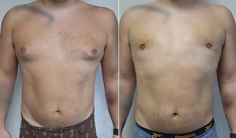 https://www.drjhall.com/wp-content/uploads/2023/05/Hall_Boston_Male-Breast-ReductionGynecomastia-38-AP.jpg