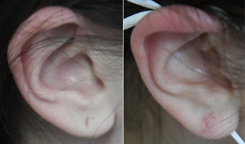 Earlobe Repair Surgery  Sound Plastic Surgery, Cosmetic Plastic