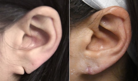 Earlobe Repair Surgery  Sound Plastic Surgery, Cosmetic Plastic