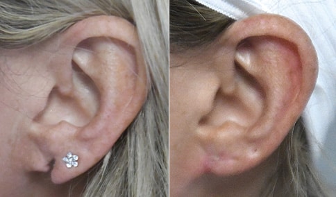 Earlobe Repair Surgery  Sound Plastic Surgery, Cosmetic Plastic