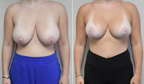 https://www.drjhall.com/wp-content/uploads/2023/10/Hall_Boston_Breast-Reduction-125-AP.jpg