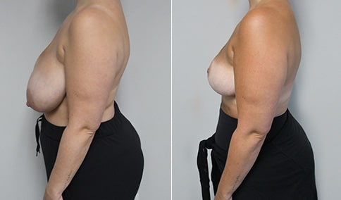 Breast Reduction  Jonathan Hall, MD, FACSJonathan Hall, MD, FACS